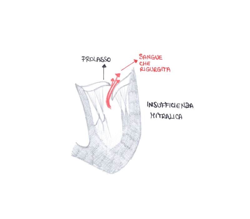 Patologia valvolare mitralica